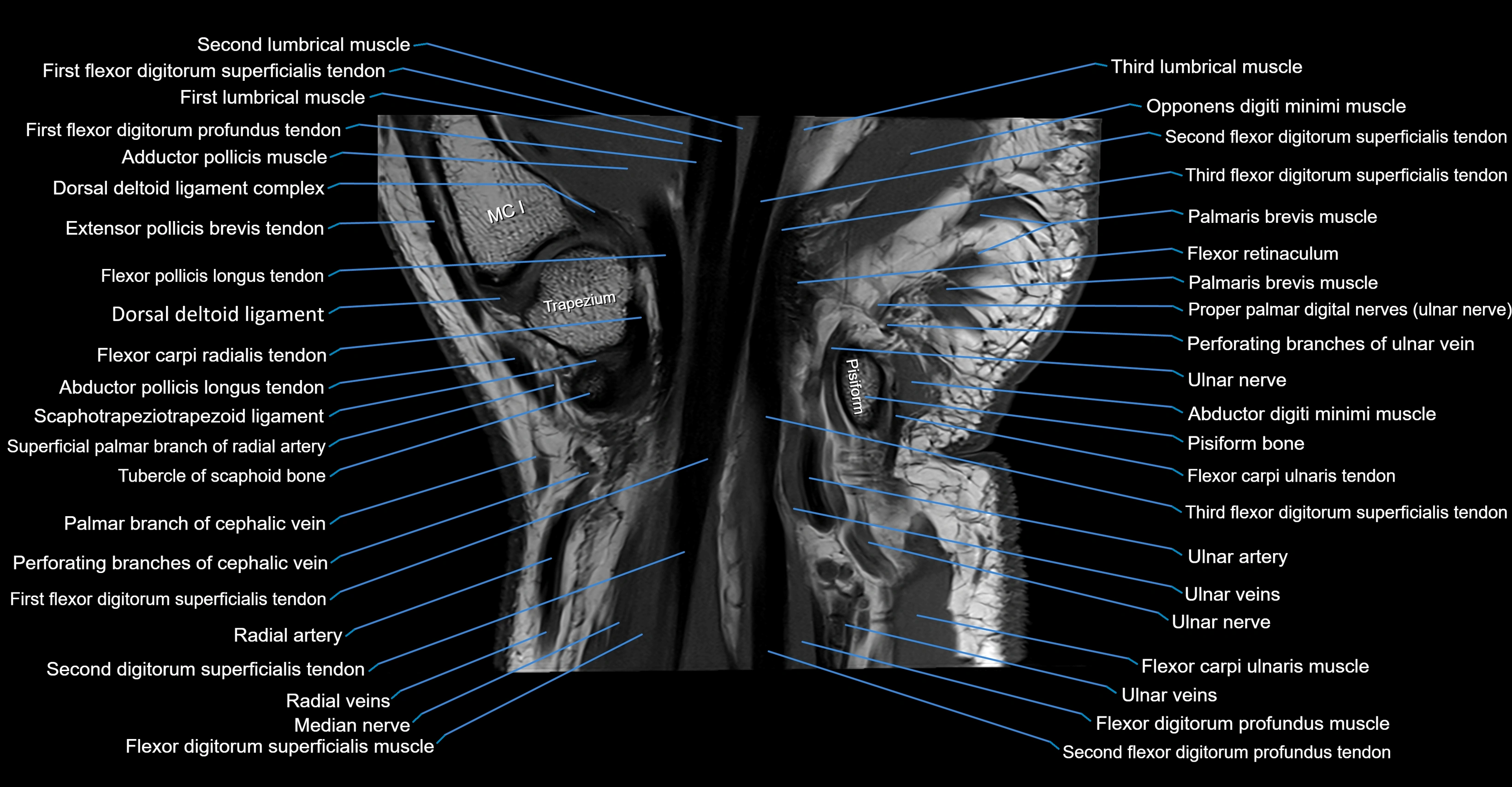 MRI wrist coronal cross sectional anatomy 3T  radiology  image-img-00001-00020.webp